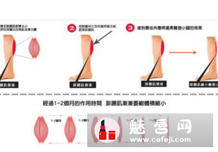 肉毒素可以瘦腿吗 多久见效